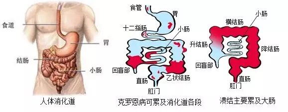 健康科普 | 炎症性肠炎患者应该这样吃