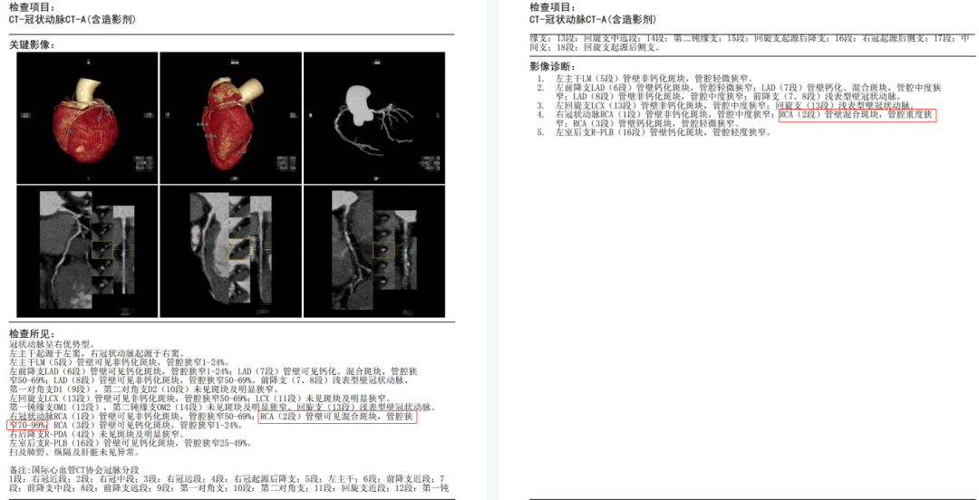 案例分享丨高端体检警惕冠脉病变