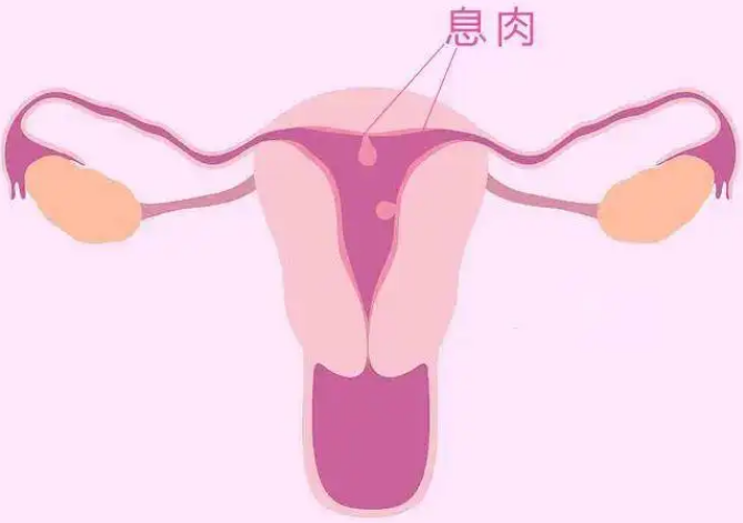 什么是子宫内膜息肉？
