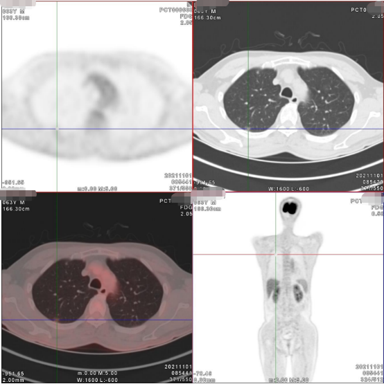 案例分享丨PET/CT明确诊断早期肺癌一例