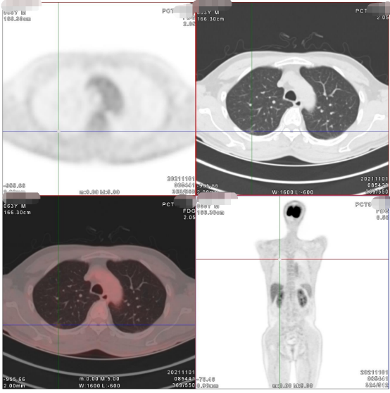 案例分享丨PET/CT明确诊断早期肺癌一例