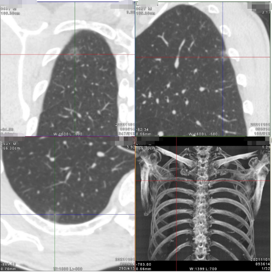 案例分享丨PET/CT明确诊断早期肺癌一例