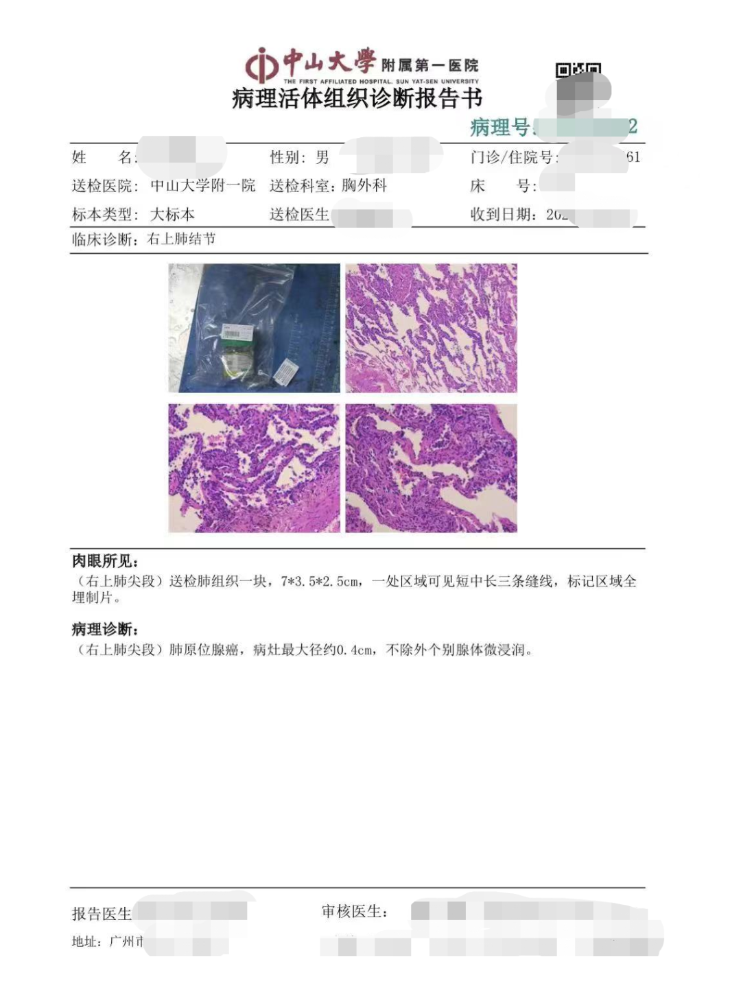 案例分享丨PET/CT明确诊断早期肺癌一例